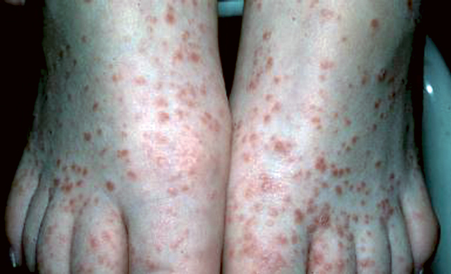 Psoriasis en gouttes